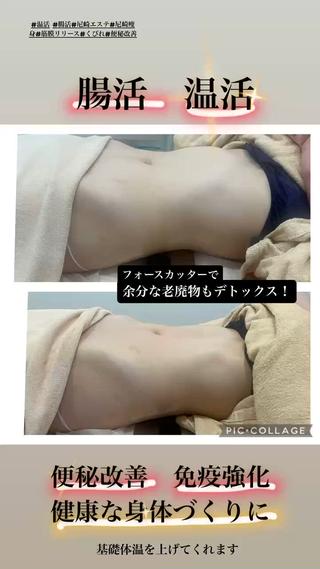 夏までにくびれ痩せ！　腹痩せ　腸活にはラジオ波モノポーラで改善！ 