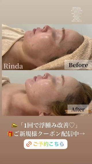 ぼやっとしていたフェイスラインが
くっきりフェイスラインへ

たるみ　浮腫み　小顔へ
直後からもリフトアップが◎

︎たるみ
︎脂肪のあつみ
︎フェイスラインのもたつき
︎ほうれい線
︎浮腫み

30代以降から気になる、フェイスライン。
年齢に応じて、原因は様々ですが、
年齢や悩みに応じて、リフトアップの施術メニューを
ご提案させて頂きます 