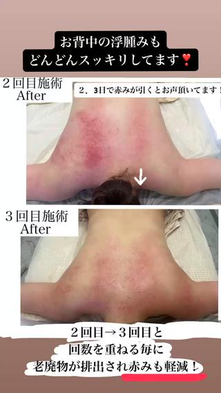 背中痩せもこのクーポンから可能！
お仕事がお忙しい方や、デスクワーク、子育ての疲れなどからくる首肩こりに！！

ブライダルエステにも人気です！ 