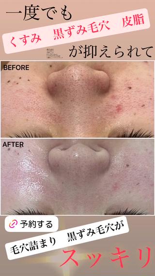 夏の時期にも気になる毛穴の黒ずみ！紫外線による細胞ダメージが原因かも？？
クリスティーナで解決しませんか？？ 