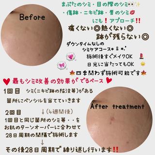 シミ・ニキビ跡の陥没・傷跡等でお悩みの方に 