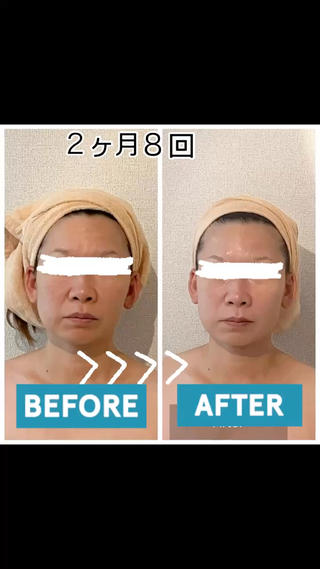 体験は¥5500  80分

︎２ヶ月で劇的たるみ•むくみ改善
︎久々の数年前の自分の顔に
︎モニターコースは定価より20%オフ料金
　　　8回1クール

ほうれい線•フェイスラインを引き上げ
あご周りもスッキリ

体験後驚く方ばかり


背中からしっかりリンパを流して筋肉緩和
　　　　　　　↓
デコルテ•首リンパゆっくり丁寧に流してほぐす
　　　　　　　↓
フェイシャルむくみ取りリンパマッサージ
　　　　　　　↓
　　　　特殊顔筋マッサージ
　　　　　　　↓
　　　　ヘッドマッサージ

 