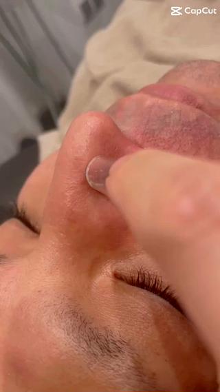 専用クレンジングで毛穴洗浄
浮き出た汚れをしっかりスポイトで吸引します。

毛穴洗浄し、お顔剃りで古い角質もお取りしたお鼻や頬はアンパンマンのようにピッカピカの鼻と頬になります
気になる毛穴汚れ、毛穴開き、毛穴の黒ずみに効果のあるモデリングマスク（剥がせるパック）でさらにもちもち肌に仕上げます 