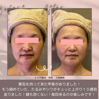 60代の女性が勇気を持ってご来店下さいまして、とってもハリのあるお肌になりリフトアップしました(^^)
若い方も多いですが、60代でもまだ綺麗になりたい気持ちはあるはず！まだ間に合います！
お待ちしておりますね♪ 