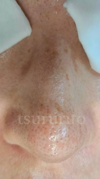 鼻の毛穴の黒ずみでお悩みの方
毛穴エクストラクションという
手法できれいになります

ビフォーアフターの写真たくさんあるので見てみてください

毛穴1個1個を丁寧に取り除き
特殊なパックで引き締めます。
マッサージ付きでお顔も身体もスッキリ！ 