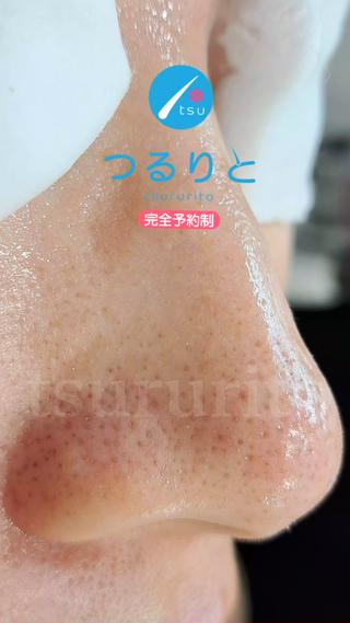毛穴詰まりがある方必見
つるりとの毛穴エクストラクションでキレイになります 