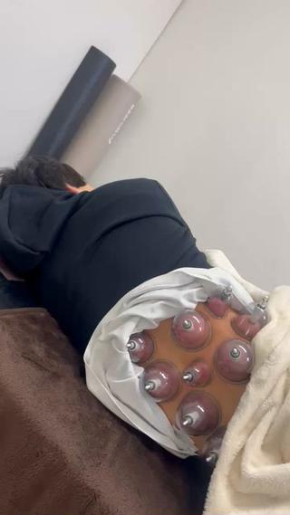 カッピング施術
アスリートにも、慢性症状にも効果覿面