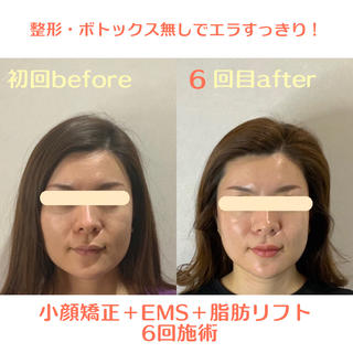 〜施術風景〜

小顔矯正＆ems＆脂肪燃焼マシン

骨格、筋肉、脂肪の全てにアプローチし
痛みなく最短リフトアップ 