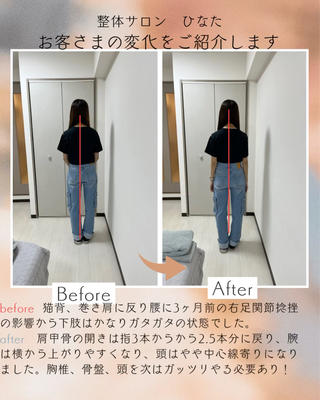 Before
猫背・巻き肩・反り腰に加え、3ヶ月前の右足関節捻挫の影響から下肢全体のバランスが大きく崩れている状態でした。
頭の前方偏位、右の強い巻き肩、反り腰、右足関節の内反、O脚による膝のねじれもみられました。

After
肩甲骨の開きが指3本分から2.5本分に改善し、腕も横から上がりやすくなりました。
頭の位置は中心線に近づき、腹筋にも力が入りやすい状態へ。動きのしやすさが出てきています。

今後は胸椎・骨盤・頭部をしっかり整え、巻き肩や骨盤周りの安定をつくっていく必要があります。
 