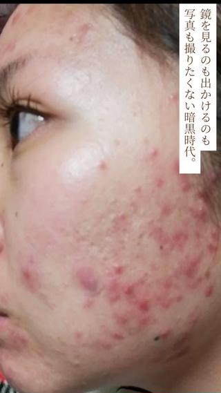 1回の成果ではありません
私です。ニキビは根気が大事！個人差があるので必ず治るとは言えません。けど1人で悩むより一緒に悩ませて下さい♡ 