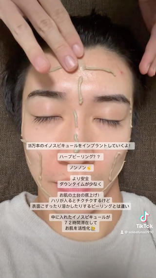 イノスピキュールピーリング

話題の『ハリ』美容！

ちくちくがたまらない！

月一ケアで肌質改善！
メンズもコツコツケアが◎ 