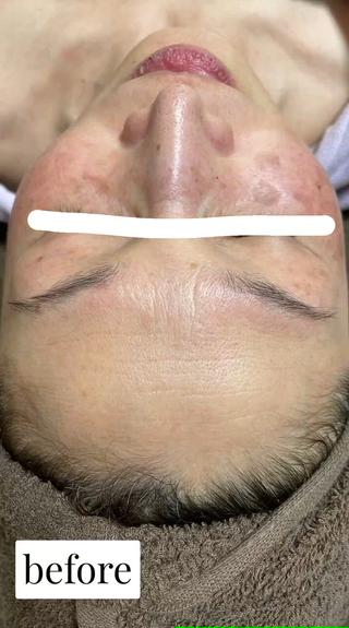 途中経過です
始めは5daysでガッツリ肌質改善、
今はソフト１dayやスペシャル1dayに変更され継続されています。
また左目の下のシミが薄くなり更にお綺麗に

before時と比べると
シミシワの減少、鼻の毛穴も綺麗に、赤みくすみが取れて顔色が明るく透明感ある素肌へと生まれ変わっています。

今ではノーファンデです

グリーンピールはエイジングの悩みにもオススメです。


その他グリーンピールでは酒さやアトピー性皮膚炎、敏感肌の方、にもオススメです 