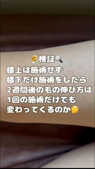 検証に付き合っていただきました

脱毛初めての方に、膝から上は施術せずに膝下だけ1回施術をさせていただきました。

2週間放置した時に毛の伸びの差がどれくらい出るかを見たかったのですが…
思っていた以上の結果になりました

もちろんここからまだ回数を重ねてもらいますが、1回目から処理してないのにすごいと感想をいただけました

脱毛は個人差がありますが1回でここまで効果が出ている例に出会い私自身も感動しました正直ここまでは稀です本当に相性が良かったみたいです

検証結果のご報告でした
 