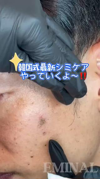 韓国式最新シミケア 