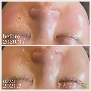 ⁡
⁡
40代前半のお客様。
ご来店より1年4ヶ月目の
ビフォーアフターです︎
⁡
赤ら顔
目元のたるみ
ほうれい線
諦めていたお悩み解消されました
⁡
サロンケア
1〜3ヵ月に1回のエステ。
クイーンフィトセルトリートメント、レストセルトリートメントをお肌の状態により施術。
ホームケア
2021.2〜
●エキスパートラッシュ
●アコライムCCクリーム
⁡
今回のメニュー
クイーンフィトセルトリートメント60分 
デコルテ・ドライヘッドスパ付き 
14300円(税込)
★初回トライヤル価格12100円(税込)
⁡
⁡
PAUSEポーズは、
【リアボーテ】・【リアムール】
正規認定サロンです。
⁡
オーナーの浜野が使用し、
安心・安全・効果・結果を
感じる事ができた商材・商品のみを
取り扱っております
⁡
お肌や頭皮、お身体のお悩みは、
お気軽にご相談ください
⁡
商品のご購入のみも承っております。
※リアボーテ・リアムール化粧品のご購入は、
対面カウンセリングが必要となります。
⁡
˗˗˗˗˗˗˗˗˗˗˗˗˗˗˗˗˗˗˗˗˗˗˗˗˗˗˗˗˗˗˗˗˗˗˗˗˗˗˗˗˗˗˗˗❀
⁡
アロマ＆エステ 
PAUSE-ポーズ-
⁡
【営業時間】
️平日:9時〜16時 ※金曜日は21時まで営業
️土日祝日:９時〜19時 ※土日祝日は、不定休
️定休日:水曜日
⁡
【ご予約・お問い合わせ】
️076-294-5778
公式ホームページ
https://hair-glean.com/este.html
⁡
˗˗˗˗˗˗˗˗˗˗˗˗˗˗˗˗˗˗˗˗˗˗˗˗˗˗˗˗˗˗˗˗˗˗˗˗˗˗˗˗˗˗˗˗˗˗˗˗˗˗˗˗˗˗❀
⁡
#リアボーテ#ボヌールエボーテ認定サロン
#ヒト幹細胞培養液エステ#無添加エステ#幹細胞コスメ#肌質改善#再生美容#クレアスキン#グランスキン#リアムール#無添加スキンケア#エステ#石川#野々市#金沢市#結果のでるエステ 