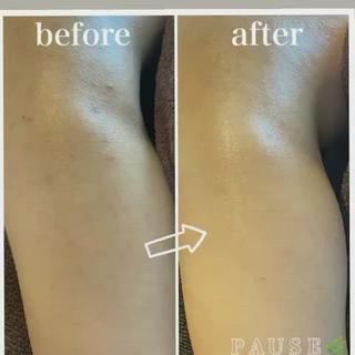 #リアボーテ
#背中ニキビケア
#ヒト幹細胞培養液エステ
⁡
タラソトリートメント5回目。
ニキビ跡にも変化が現れてまいりました
⁡
ホームケア
エキスパートトータルクレンジング
ホームケアに#リアムールエキスパートトータルクレンジング＆#リアムールトータルでバランスコンディションのご使用がおすすめです
ニキビ改善のスピードが違います
⁡
⁡
長年の肌トラブル、本気の肌質改善は
少しお時間がかかりますが
正しいお手入れをすれば
お肌は、変われます︎
⁡
本気の肌質改善、肌再生ケアを
求めている方はお気軽にご相談ください
⁡
⁡
背中ニキビケアメニュー
・
お肌の状態に合わせて4種類のエステより
組み合わせていきます。
※施術部位は、背中上部となります。
⁡
⁡
PAUSEポーズは、
【リアボーテ】・【リアムール】
正規認定サロンです。
⁡
オーナーの浜野が使用し、
安心・安全・効果・結果を
感じる事ができた商材・商品のみを
取り扱っております
⁡
お肌や頭皮、お身体のお悩みは、
お気軽にご相談ください

⁡
商品のご購入のみも承っております。
※リアボーテ・リアムール化粧品のご購入は、
対面カウンセリングが必要となります。
⁡
˗˗˗˗˗˗˗˗˗˗˗˗˗˗˗˗˗˗˗˗˗˗˗˗˗˗˗˗˗˗˗˗˗˗˗˗˗˗˗˗˗˗˗˗❀
⁡
アロマ＆エステ 
PAUSE-ポーズ-
⁡
【営業時間】
️平日:9時〜16時 ※金曜日は21時まで営業
️土日祝日:９時〜19時 ※土日祝日は、不定休
️定休日:水曜日
⁡
【ご予約・お問い合わせ】
️076-294-5778
公式ホームページ
https://hair-glean.com/este.html
⁡
˗˗˗˗˗˗˗˗˗˗˗˗˗˗˗˗˗˗˗˗˗˗˗˗˗˗˗˗˗˗˗˗˗˗˗˗˗˗˗˗˗˗˗˗˗˗˗˗˗˗˗˗˗˗❀
⁡
#リアボーテ#ボヌールエボーテ認定サロン
#ヒト幹細胞培養液エステ#無添加エステ#幹細胞コスメ#肌質改善#再生美容#クレアスキン#グランスキン#リアムール#無添加スキンケア#エステ#石川#野々市#金沢市#結果のでるエステ 