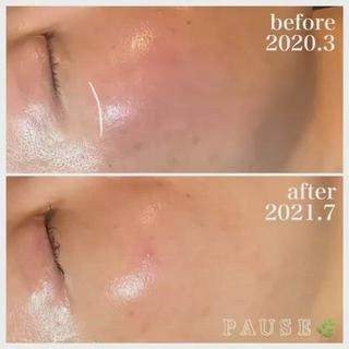 ⁡
⁡
40代前半のお客様。
ご来店より1年4ヶ月目の
ビフォーアフターです︎
⁡
赤ら顔
目元のたるみ
ほうれい線
諦めていたお悩み解消されました
⁡
サロンケア
1〜3ヵ月に1回のエステ。
クイーンフィトセルトリートメント、レストセルトリートメントをお肌の状態により施術。
ホームケア
2021.2〜
●エキスパートラッシュ
●アコライムCCクリーム
⁡
今回のメニュー
クイーンフィトセルトリートメント60分 
デコルテ・ドライヘッドスパ付き 
14300円(税込)
★初回トライヤル価格12100円(税込)
⁡
⁡
PAUSEポーズは、
【リアボーテ】・【リアムール】
正規認定サロンです。
⁡
オーナーの浜野が使用し、
安心・安全・効果・結果を
感じる事ができた商材・商品のみを
取り扱っております
⁡
お肌や頭皮、お身体のお悩みは、
お気軽にご相談ください
⁡
商品のご購入のみも承っております。
※リアボーテ・リアムール化粧品のご購入は、
対面カウンセリングが必要となります。
⁡
˗˗˗˗˗˗˗˗˗˗˗˗˗˗˗˗˗˗˗˗˗˗˗˗˗˗˗˗˗˗˗˗˗˗˗˗˗˗˗˗˗˗˗˗❀
⁡
アロマ＆エステ 
PAUSE-ポーズ-
⁡
【営業時間】
️平日:9時〜16時 ※金曜日は21時まで営業
️土日祝日:９時〜19時 ※土日祝日は、不定休
️定休日:水曜日
⁡
【ご予約・お問い合わせ】
️076-294-5778
公式ホームページ
https://hair-glean.com/este.html
⁡
˗˗˗˗˗˗˗˗˗˗˗˗˗˗˗˗˗˗˗˗˗˗˗˗˗˗˗˗˗˗˗˗˗˗˗˗˗˗˗˗˗˗˗˗˗˗˗˗˗˗˗˗˗˗❀
⁡
#リアボーテ#ボヌールエボーテ認定サロン
#ヒト幹細胞培養液エステ#無添加エステ#幹細胞コスメ#肌質改善#再生美容#クレアスキン#グランスキン#リアムール#無添加スキンケア#エステ#石川#野々市#金沢市#結果のでるエステ 