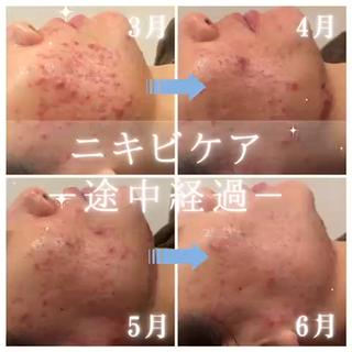 
#リアボーテ
#大人ニキビケア
⁡
30代のお客様。
長年のしつこいニキビ解消に向けて
頑張っていらっしゃいます
⁡
毎月、
ご来店の度に変化しております！
⁡
長年のニキビの解消には、
少し時間がかかりますが、変われます
⁡
ニキビのお悩みは、
お気軽にご相談ください
⁡

⁡
⁡


⁡ 