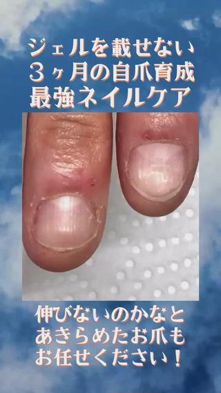 インスタグラムにお客様の成育経過を随時投稿しております
@nail_salon_pause←過去の投稿はこちら
自爪育成「最強ネイルケア」モニター様の育成経過です
༶
こちらはケア𝟔回目終了後の様子
初回のご来店から約𝟏ヶ月半経過しました
༶
初回ご来店時はお試しコースでお越し頂き、
その一回でもキレイになったので、
༶
「どうせならちゃんとやりたいです！」
とあらためて𝟑ヶ月コースをお申込み頂きました
༶
素晴らしいですね
お試し𝟏回の際にそのまま𝟑ヶ月コースをお申込み頂き、お試し回の施術を最初の𝟏回分、として頂くのも𝐎𝐊ですよ
༶
ご家族にも「すごく変わったね！」と言われるので嬉しいとおっしゃられています
༶
噛み爪やむしり癖に悩まれていて、
お爪周りの皮膚も荒れがちでしたが、
オイルでしっかり保湿をこまめにして頂き、
みるみる改善されました
༶
噛み爪の影響で
お爪に凹凸があったのですが、
爪の先端に移行して伸びていってるの、
伝わりますでしょうか？
༶
ここ伸ばして無くしましょうね〜もうちょっとですね〜！と毎回お客様と一緒に
確認しています
༶
新たに伸びたお爪は
「シャキーン！」と真っ直ぐな
健康なお爪が生えてきています
༶
引き続きこの調子でいきましょう
キレイが止まりません！𝐰
今後もとっても楽しみです
༶
一緒に頑張りましょうね
༶
育成するなら夏が絶対おススメですよ〜！
と言う話をホームページのブログにも𝟑記事程投稿してますので、(多い！笑)
ぜひご覧ください
𝐬𝐚𝐥𝐨𝐧𝐩𝐚𝐮𝐬𝐞.𝐜𝐨𝐦
(プロフィール欄のリンクから閲覧できます)
༶
早く始めた方から早く変わっていきます
無料𝐋𝐈𝐍𝐄相談も受付中！お気軽にお問い合わせください
@𝟎𝟒𝟑𝐨𝐜𝐦𝐟𝐚
༶
✺自爪育成最強ケア
第二弾モニター様は満席となりました！
第三弾モニター様、𝟑名限定先着順で募集いたします！
✪𝟑ヶ月間　サロン施術𝟖〜𝟏𝟎回・カウンセリング・施術後の経過写真コラージュプレゼント・育成オイル含むホームケア用品込
¥𝟔𝟕,𝟐𝟎𝟎(税込)¥𝟓𝟓,𝟎𝟎𝟎(税込)
⁡
残席名様となりました！
既に複数お問い合わせ頂いておりますので、
気になられている方はお早目にご連絡くださいませ！
༶
༶
༶
𝐉𝐑京都線　千里丘駅から徒歩𝟐分
【最強ネイルケア＆手の病院サロン取扱店】
自爪で過ごされるお客様を、健康なお爪・手肌に導くサポートを行って参ります
𓇠𓇠𓇠𓇠𓇠𓇠𓇠𓇠𓇠𓇠𓇠𓇠𓇠𓇠𓇠
𝐩𝐫𝐢𝐯𝐚𝐭𝐞 𝐧𝐚𝐢𝐥 𝐬𝐚𝐥𝐨𝐧 𝐏𝐚𝐮𝐬𝐞（ポーズ）
〒𝟓𝟔𝟔-𝟎𝟎𝟏𝟏
大阪府摂津市千里丘東𝟑-𝟏𝟎-𝟏𝟓 西村ビル𝟑𝟎𝟏号
(𝟏階に鳥貴族さんのあるビルの𝟑階です️)
月・水・金・日・祝
→𝟏𝟎:𝟎𝟎〜𝟐𝟐:𝟎𝟎(最終受付𝟏𝟗:𝟎𝟎)
火・木→定休日
𓇠𓇠𓇠𓇠𓇠𓇠𓇠𓇠𓇠𓇠𓇠𓇠𓇠𓇠𓇠
༶
༶
༶
#ネイルケア #千里丘ネイルサロン #北摂ネイルサロン #摂津市ネイルサロン #摂津市自爪育成 #摂津市ネイルケア #吹田市 #摂津市 #千里丘 #正雀 #爪の悩み #千里丘ネイル #摂津市ネイル #地爪育成 #自爪育成 #自爪育成サロン #育爪 #最強ケア #最強ネイルケア #最強ケア大阪 #噛み爪 #深爪 #薄い爪 #噛み爪改善 