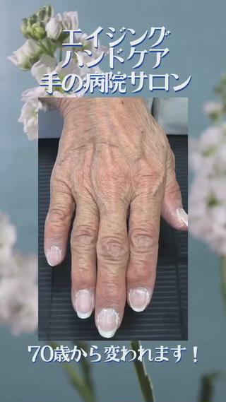 インスタグラムにお客様の経過を投稿しております
@nail_salon_pause

毎日の日焼けケアにもおススメの「エイジングケアハンドエステ『手の病院サロン』」
༶
手のシワやたるみくすみ…気になるけどあきらめるしかないのかな？と思われていませんか？
༶
こちらのお客様はおおよそ月に1回の頻度の施術で、まだ5回目ですが、
回を重ねる毎に、潤いはもちろんのこと、
透明感も上がり、血色も良くなり、
血管の浮きも気にされていましたが、目立たなくなってきています
༶
お肌がイキイキとされている様子がわかります触った質感もとても柔らかくなりました
༶
驚きなのが70歳のお客様なんです！(許可は頂いていますw)
༶
最初のほうは「まあ若い人は結果出るよね…もうキレイやもんな…」と毎回のようにおっしゃられてましたがw、
༶
回を重ねるごとにキレイになる様子を実感されて、とても自信がついて、ホームケアもとても楽しくなられたそうです
嬉しいですね〜
༶
何歳からでも変わりたい気持ちを持つことが
まず大事です！
その強い気持ちさえあれば、当店は全力でサポートさせて頂きますよ！
༶
早く始めた方から早く変わっていきます
無料𝐋𝐈𝐍𝐄相談も受付中！お気軽にお問い合わせください
༶
ご予約、お問い合わせは
公式𝐋𝐈𝐍𝐄から
お願い致します
@𝟎𝟒𝟑𝐨𝐜𝐦𝐟𝐚
༶
お友達追加後、
ご質問内容を
メッセージにてお送りくださいませ
確認できましたら
折り返しご連絡させて頂きます
༶
༶
༶
𝐉𝐑京都線　千里丘駅から徒歩𝟐分
【最強ネイルケア＆手の病院サロン取扱店】
自爪で過ごされるお客様を、健康なお爪・手肌に導くサポートを行って参ります
𓇠𓇠𓇠𓇠𓇠𓇠𓇠𓇠𓇠𓇠𓇠𓇠𓇠𓇠𓇠
𝐩𝐫𝐢𝐯𝐚𝐭𝐞 𝐧𝐚𝐢𝐥 𝐬𝐚𝐥𝐨𝐧 𝐏𝐚𝐮𝐬𝐞（ポーズ）
〒𝟓𝟔𝟔-𝟎𝟎𝟏𝟏
大阪府摂津市千里丘東𝟑-𝟏𝟎-𝟏𝟓 西村ビル𝟑𝟎𝟏号
(𝟏階に鳥貴族さんのあるビルの𝟑階です️)
月・水・金・日・祝
→𝟏𝟎:𝟎𝟎〜𝟐𝟐:𝟎𝟎(最終受付𝟏𝟗:𝟎𝟎)
火・木→定休日
𓇠𓇠𓇠𓇠𓇠𓇠𓇠𓇠𓇠𓇠𓇠𓇠𓇠𓇠𓇠
༶
༶
༶
#ハンドケア #ネイルケア #千里丘ネイルサロン #北摂ネイルサロン #摂津市ネイルサロン #摂津市自爪育成 #摂津市ハンドケア #摂津市 #千里丘 #正雀 #爪の悩み #千里丘ネイル #摂津市ネイル #地爪育成 #自爪育成 #自爪育成サロン #摂津市ハンドエステ #手の病院サロン #手の病院サロン導入店 #エイジングケア  