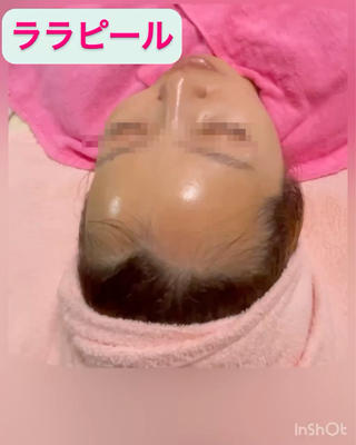 韓国女優肌の様な【艶肌】になるララピール!
みてもらえると必見です!
この艶肌感!
ただ今、【キャンペーン中】ご予約お待ちしています。