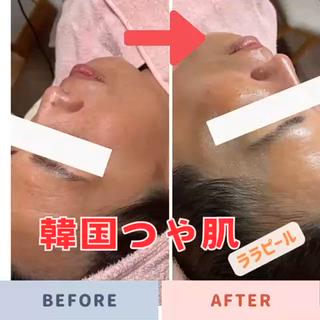 たくさんのお客様、ありがとうございます。
第4世代の【肌を育てるピーリング】ララピール
不要な角質のみ取り除き、お肌に必要な物質だけ残すので、刺激が少なく、ダウンタイムがありません!
【毛穴】【ザラつき】にも効果ありです。
一度で、韓国女優の様な艶々肌に、
限定価格中です。