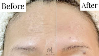 施術1回でのBefore→Afterです。
おでこだけではなく、ほうれい線、フェイスライン、目の下など

たるみ、お悩み全てお任せください。 