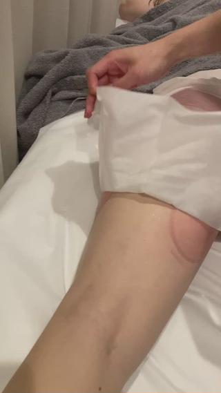 脂肪冷却後、カップの吸引によりこの様な赤みが出ますが1​〜​2時間ほどで基本は消えます
#脂肪燃焼#痩身#六本木痩身#ダイエット
#東京冷却 