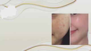 ハーブピーリング
ベルギー皮膚科医開発の
2Bフェイシャル
※翌日、運動、水泳、カラーリング
メイク不可 