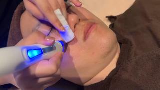 毛穴の汚れ吸引中 