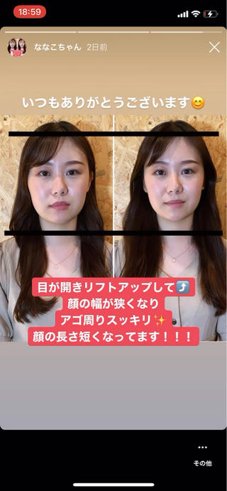 合計3回の施術効果です！
1回目　→   2回目　→   3回目
3回でこれだけ変わります 