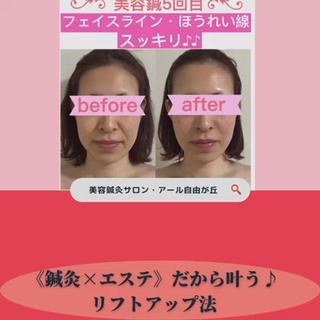 美容鍼施術工程です♪ 
