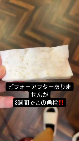 3週間でこれだけ取れました
お客様もビックリ
そしてエクストラクションを始めてから
ニキビが出来なくなったと嬉しい
報告ニキビの玉子も取るので
本当にお肌が綺麗になりました 