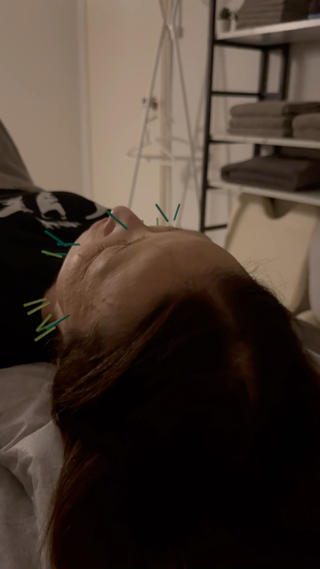 美容鍼で定期的な肌メンテナンス
1ヶ月に1回の施術がおすすめです 