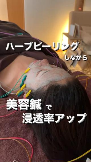 ハーブピーリングをしっかり浸透させる間
美容鍼で体の内側から血行促進

するとハーブがより浸透して
美肌効果が高くなりますきら 