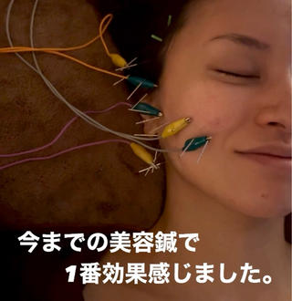 美容鍼は美容医療でもエステでも敵わない効果がありますよね️ 