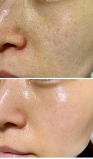 提携の美容皮膚科クリニックでは7万円する施術です
どうぞモニター価格でお試しください。 