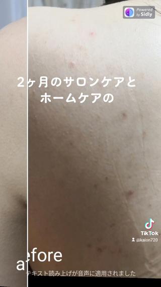 背中ニキビを改善 