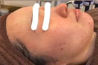 ハーブピーリング、before  after動画

写真より、もっともっとbefore afterが
分かりやすいので、ぜひぜひご覧あれー

ディープクレンジング→濃密泡洗顔→ホットタオル→毛穴吸引→ハーブ導入→保湿＋鎮静パック→お仕上げ、、、 