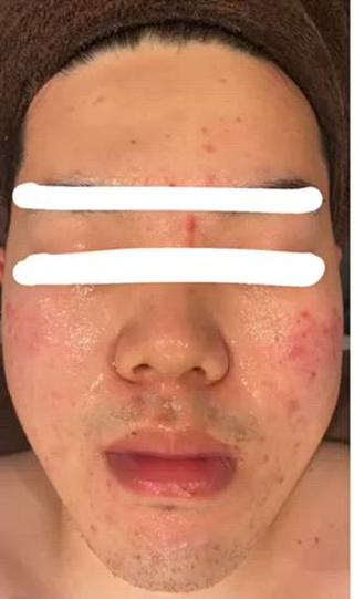 メンズも大歓迎です
ハーブピーリング、before  after動画

写真より、もっともっとbefore afterが
分かりやすいので、ぜひぜひご覧あれ

ディープクレンジング→濃密泡洗顔→ホットタオル→毛穴吸引→ハーブ導入→保湿＋鎮静パック→お仕上げ、、、 