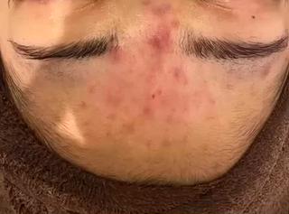 ハーブピーリング（剥離有り） 