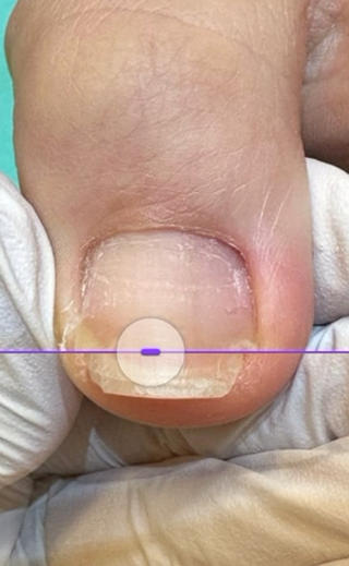 巻き爪補正　巻き爪　
 