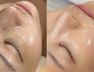 5月30日よりSTART\韓国発!最新艶肌美容/

⁡専用のマシンで生美容液を導入！今までにない艶肌へ導きます
⁡ 