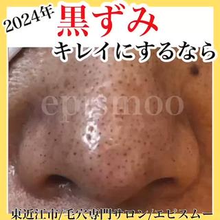 2024年
毛穴悩み解消しませんか？

こんな方にオススメ
■ 鼻の黒ずみ毛穴やいちご鼻
■皮脂詰まり、角栓
■ ザラつき毛穴
■毛穴の凹凸、開き
■メイク崩れ、厚塗り
■ 毛穴のファンデが詰まる
■ 鼻のテカリ
■ 長年毛穴の悩みが改善しない

一つでも当てはまる方！
毛穴キレイになります 