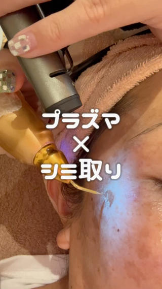 茨城に一台しかない
プラズマシャワープラズマシミ取り
完全予約、待ち時間なしのシミ取りです◎
顔以外にも首イボや腕、手なども人気です！ 