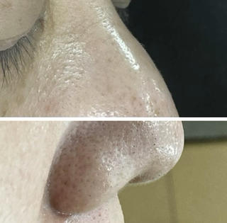 鼻の黒い小さなポツポツ気になりませんか？
このポツポツ、拡大鏡でよーく観察して丁寧に取り除くと
その正体は…「毛」だったのです。
皮脂に絡みついて抜け落ちることができなかった毛。
取り除くとその長さ3ミリほど。毛穴は深いです。
表面からは黒いポツポツだったのに…。

毛穴のお悩み、自己処理では難しいです。
ぜひプロにおまかせください(^^) 