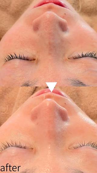 毛穴エクストラクションで毛穴の汚れを除去した後、美容液を深部へ届けます。ハリとツヤが蘇り、次の日の触り心地も感動です☆ 