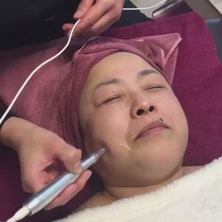 最新美容機器『メタジェクト』！！クリニックのダーマローラー のエステ版！！肌に空洞を作り、修復作用が働きコラーゲン、エラスチンの生成を促進させます！！ 