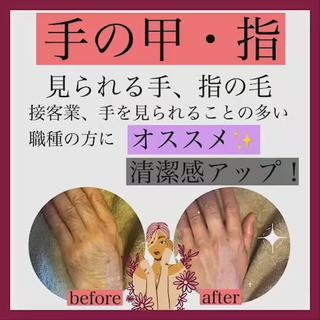 接客業の方必見!【手の指、甲】脱毛でこの仕上がり?!