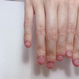 このくらい深爪でも大丈夫です 
